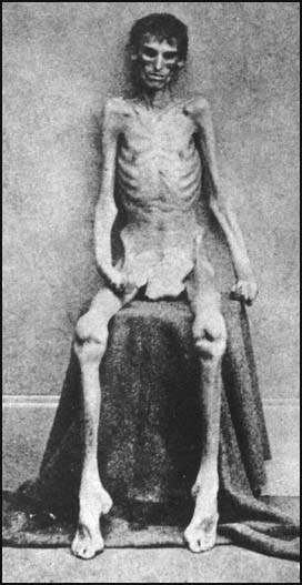 UNION SOLDIER UPON RELEASE FOR ANDERSON CONCENTRATION CAMP!